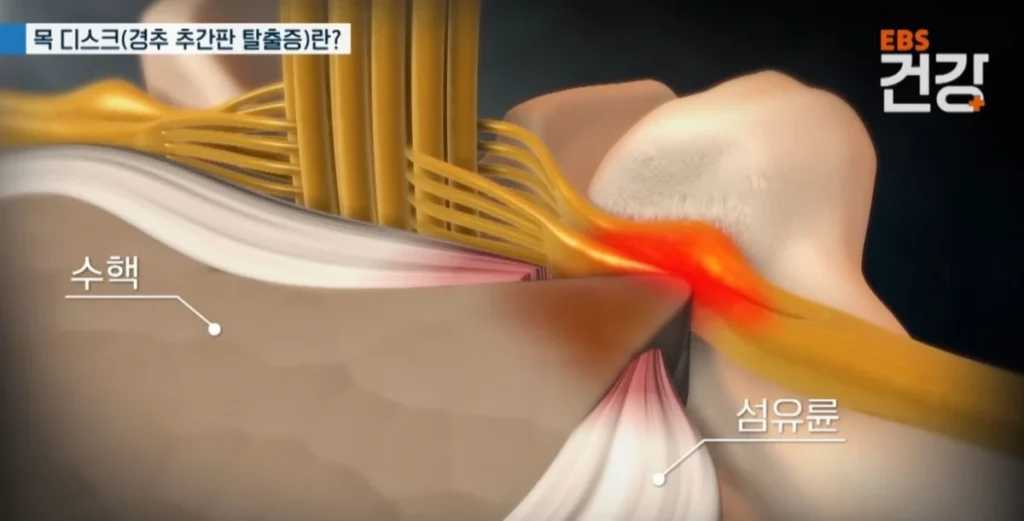 목디스크-증상