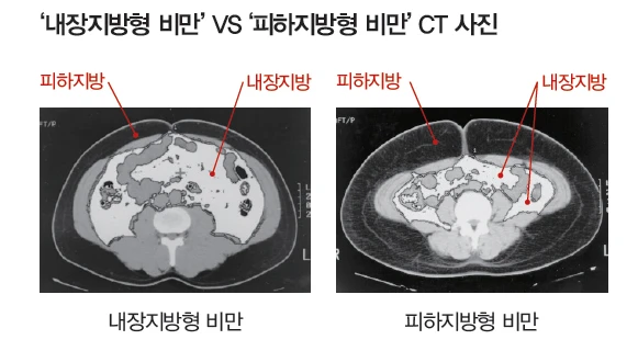 내장지방-피하지방-CT