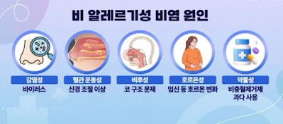 비알레르기성 비염