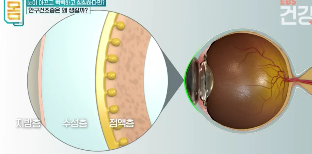 안구건조증-원인