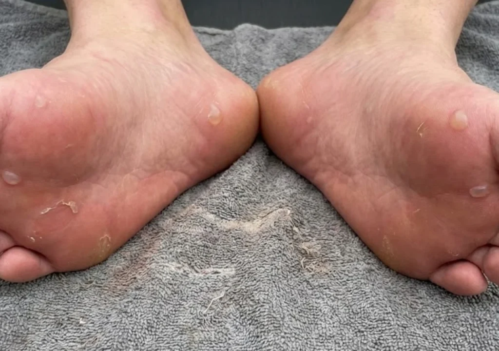 러닝-물집-예방