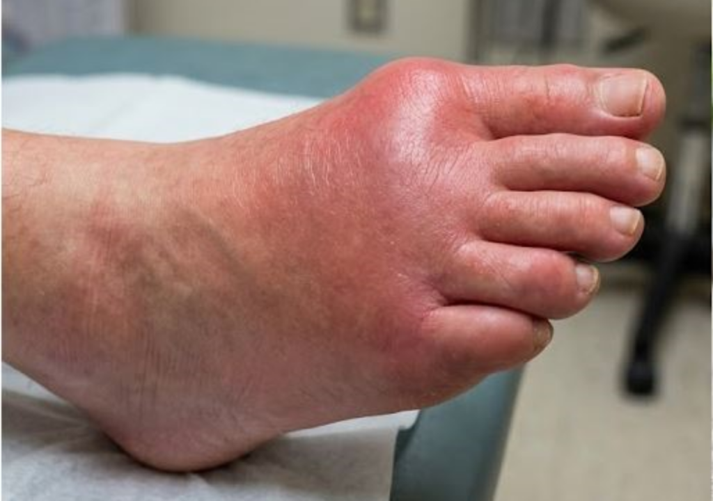 통풍-요산-수치-낮추는-법